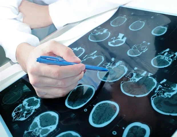 ALS risk varies significantly across U.S. military service branches