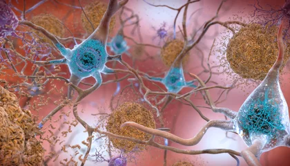 Experimental Alzheimer's Drug That Fights a Tough-to-Target Protein Shows Promise at Slowing Cognitive Decline in a Clinical Trial