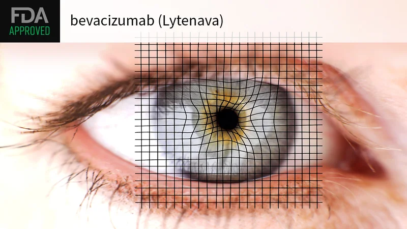 FDA Approves Branded Bevacizumab for Wet AMD