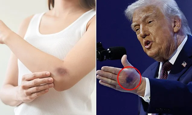 Bruise easily? When to ignore your black and blues and when they're a sign of something sinister