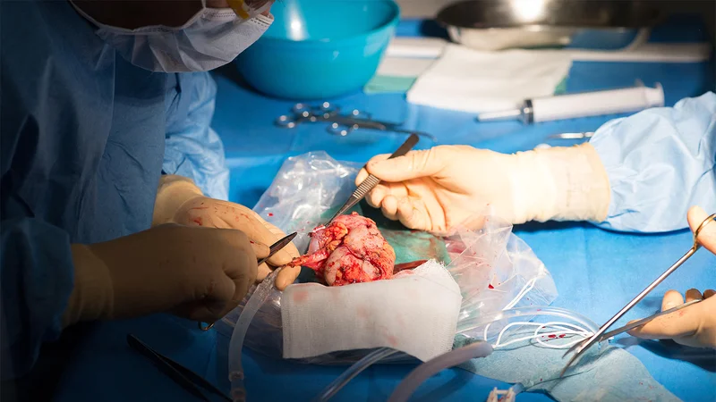 COVID Study Supports Antiviral Use in Kidney Transplant Recipients