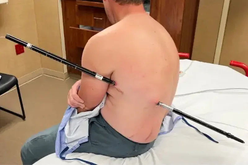 A steel pole pierced his body. He hiked 10 miles off a mountain anyway.