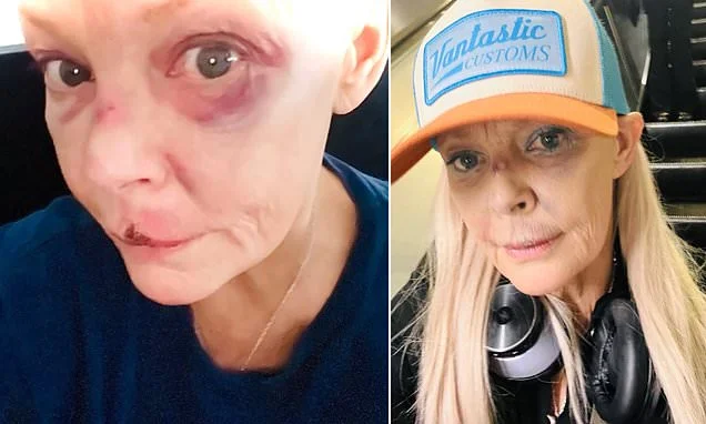 Gail Porter reveals black eye and bruised cut lip after she was knocked down the stairs at a London tube station as she urges keyboard warriors to be 'kind to her'