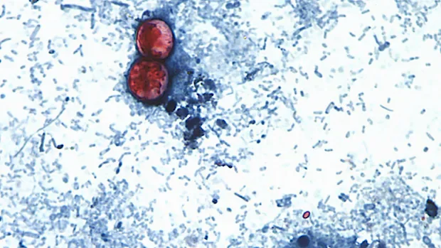 U.S. identifies cyclosporiasis cases in 4 more states, widening investigation