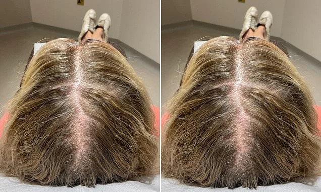 I was so ashamed of my thinning menopausal hair that I wore a hair piece and spent £60,000 trying to cure my bald spots. This is what finally worked (and it wasn't any serum or transplant!) KATIE BRINDLE