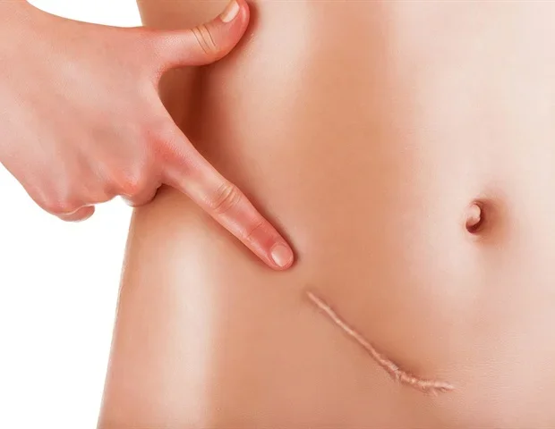 Phase 3 clinical trial enrolls first platinum-resistant ovarian cancer patient