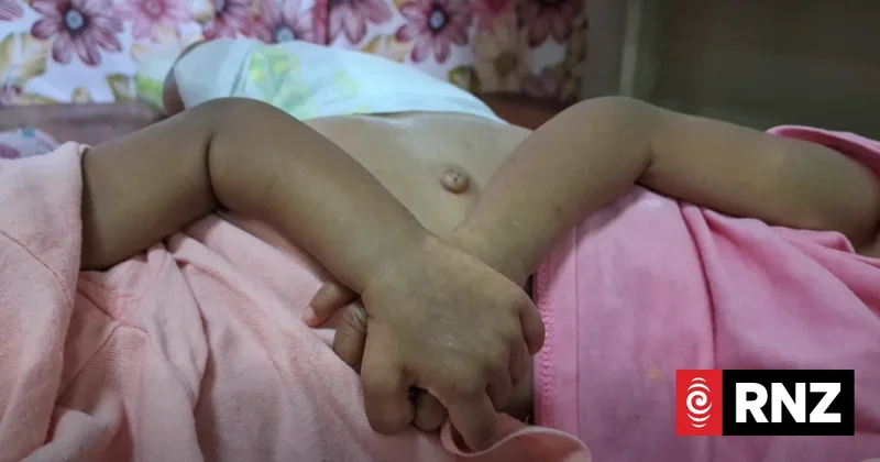 Fiji conjoined twins prepare for life-saving surgery in Saudi Arabia