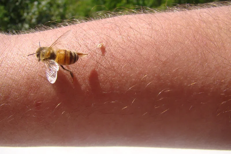 Woman turns to bee venom therapy to treat Lyme disease symptoms
