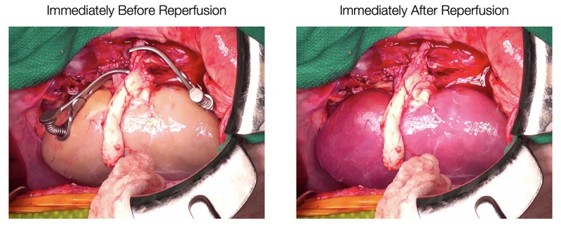 Supercooled kidneys have been transplanted into pigs in a “landmark achievement”