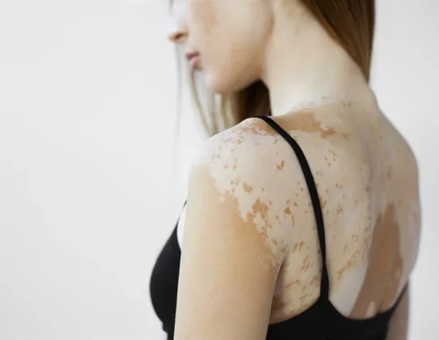 Dormant melanocytes found in vitiligo offer hope for future repigmentation therapies