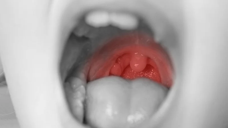 Oral Steroids After Tonsillectomy May Modestly Cut Kids' Pain