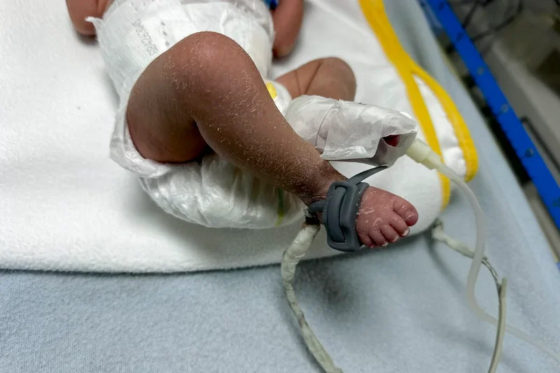 Miscarriages soar in Gaza and birth rate drops, UN report finds