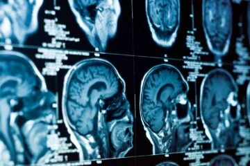 Amsterdam researchers find remedy for fatal child brain disease