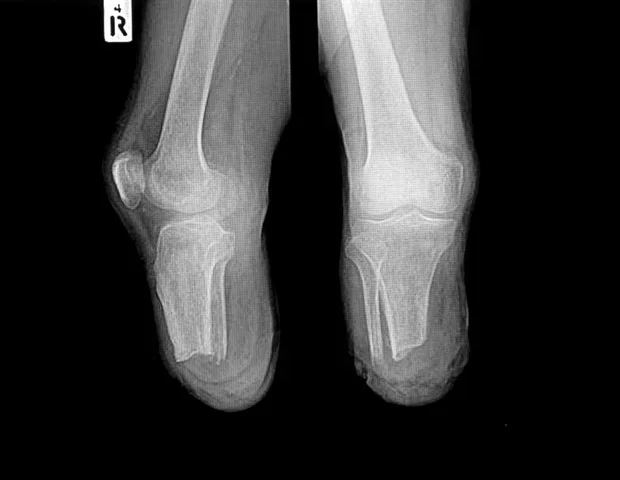 Researchers identify molecular targets to treat painful nerve neuromas