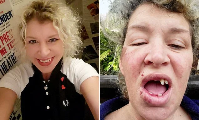 Mother, 48, loses seven teeth when she trips over pothole in the dark as council refuses compensation