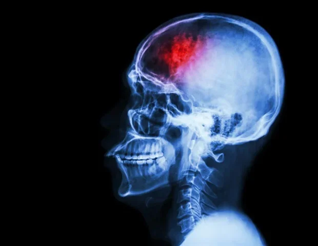 Early-onset epilepsy tied to lower academic achievement