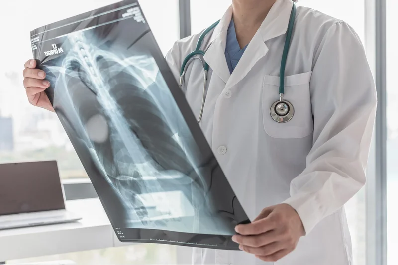 Years After He Quit Smoking, a Lung Cancer Scan Saved His Life