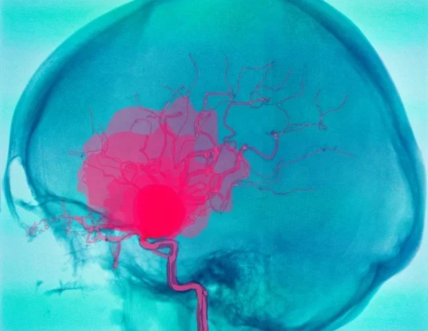 LVIS stent-assisted coiling effectively treats wide-necked intracranial aneurysms
