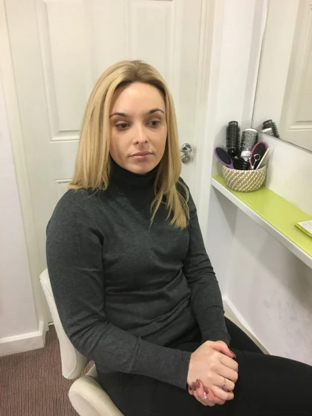My life with alopecia: I tried everything, even rubbed cabbage stalks on my bald head for weeks