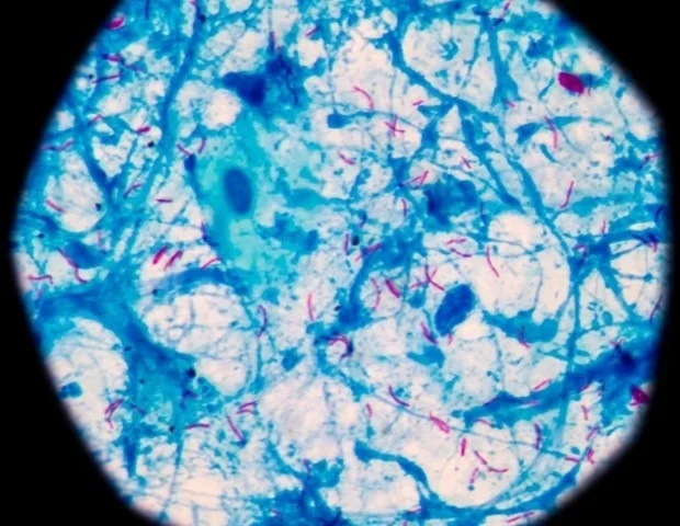 Men’s higher TB burden linked to greater exposure