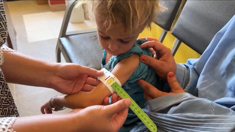 Deadliest form of malnutrition has reached critical levels in Afghanistan