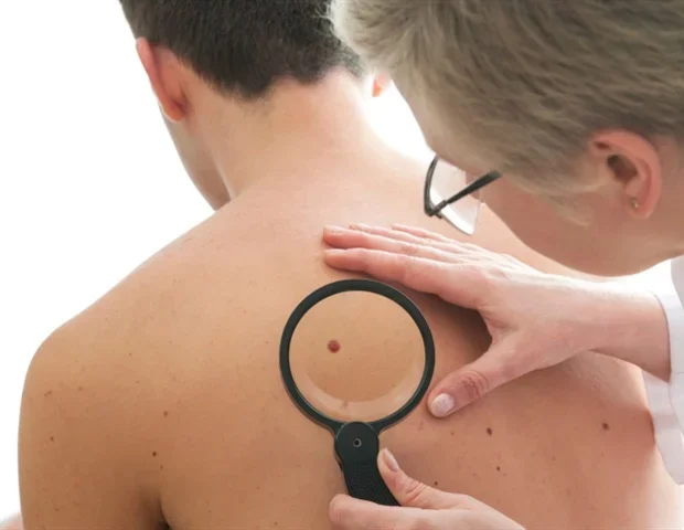 HonorHealth begins trial of dendritic cell vaccine for advanced melanoma