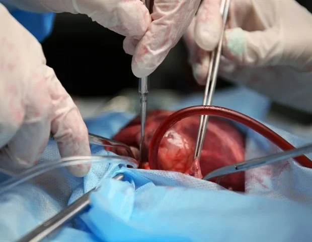 Intravenous iron before heart surgery cuts transfusion needs