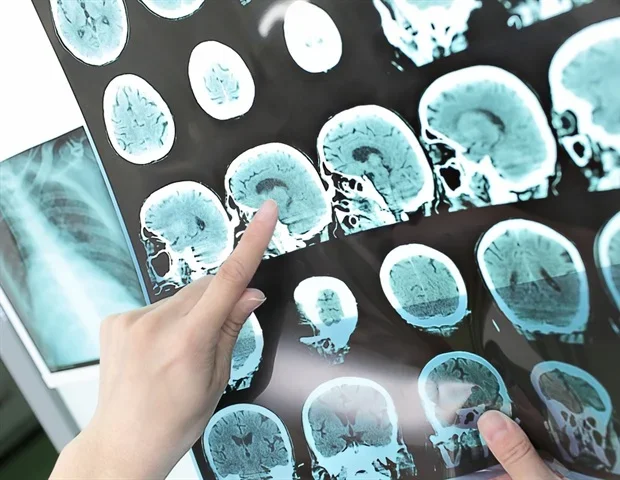 Automated MRI system improves improves evaluation of experimental stroke therapies