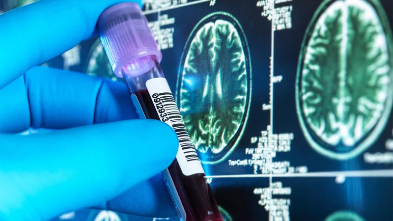 FDA Clears Novel Alzheimer's Blood Test