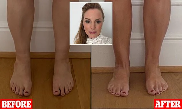 How I FINALLY got rid of my cankles: Compression trousers may look ludicrous, but here's why me and my newly slender youthful ankles are hooked