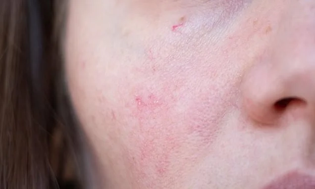What that crusty red spot on your face really means: So many are told the mark that won't go away is eczema or psoriasis. But this is how to tell when it's something far more sinister, reveals DR PHILLIPA KAYE