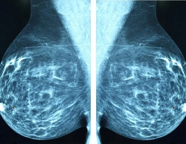 Breast cancer co-opts the immune system to attract nerves that fuel tumor growth