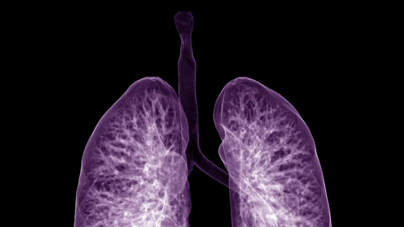 STAT+: Sionna’s experimental cystic fibrosis pill falls flat in mid-stage trial
