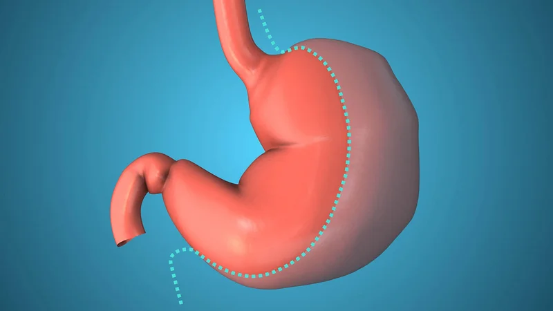 Bariatric Surgery Remains an Important Option for Obesity, Despite GLP-1 Drug Boom