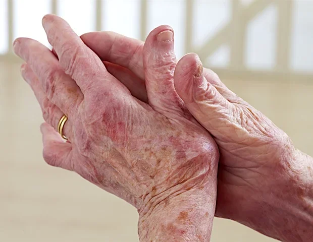 EuroSpA study links country income to arthritis treatment outcomes