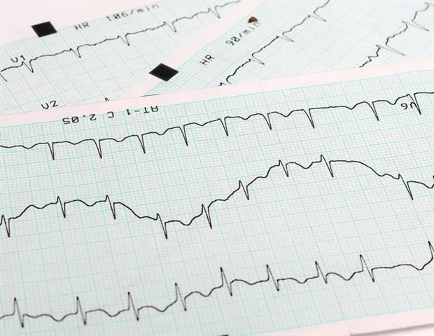 AI-enabled stethoscope frequently misses heart murmurs in companion animals