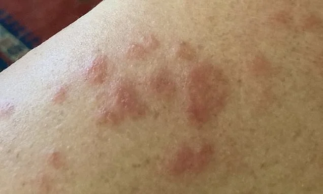 For more than 30 years experts dismissed my angry red hives as rosacea. In fact, I have an autoimmune condition that affects thousands of menopausal women but is often misdiagnosed. These are the other symptoms to look out for