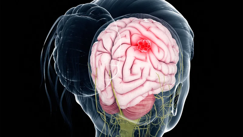 Leptomeningeal Disease in HER2-Positive Metastatic Breast Cancer