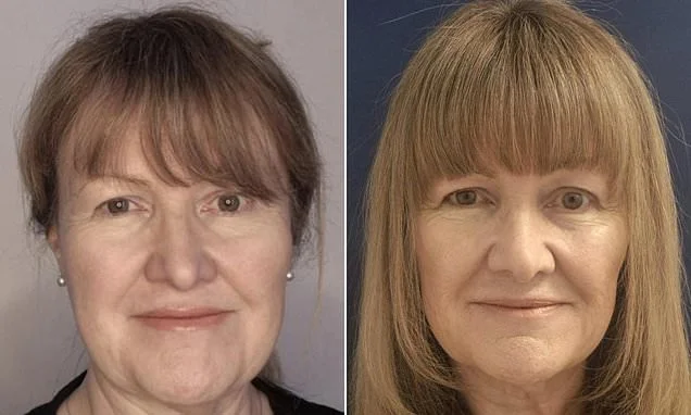 After being widowed, the deep vertical line above my lip made me so self-conscious about my grieving face. A £400 tweakment took years off my whole look at 63 - and gave me confidence to start living again