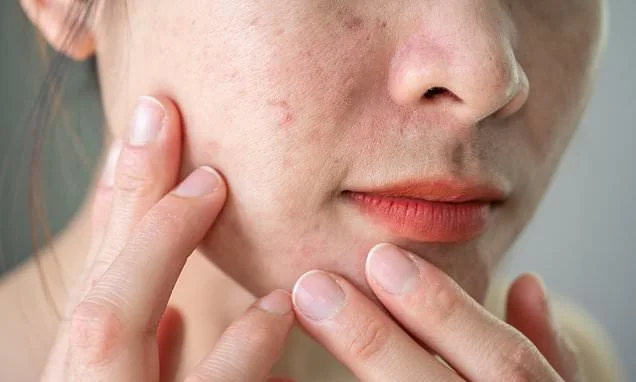 The daily routine and diet that could transform psoriasis-prone skin in just six weeks... and the 'healthy' daily drink that could be your worst enemy