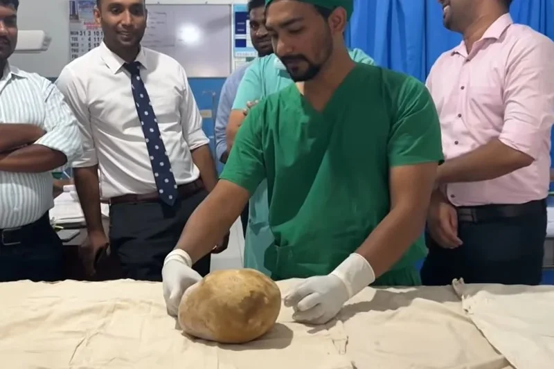 Sri Lankan hospital claims record after removing 3.1kg stone from man’s bladder